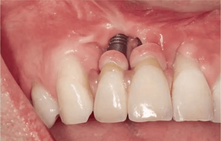 Top 7 Major Causes of Dental Implant Failure