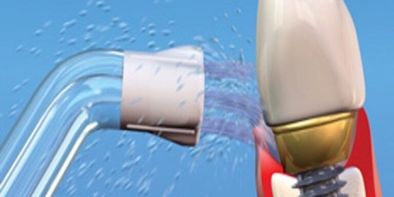 Your Role in Dental Implant Success: Home Care is Crucial